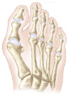 photo of foot with bunion