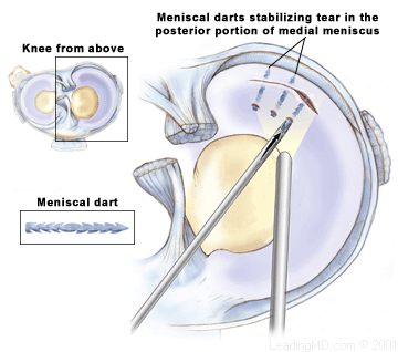 Meniscal Replacement